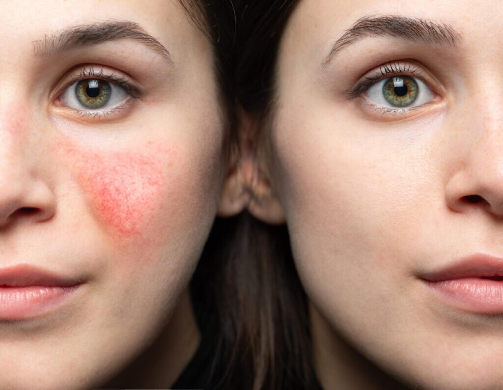 Tratament Redness PEEL