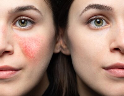 Tratament Redness PEEL